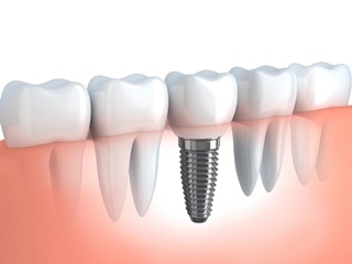 Импланты в стоматологии Израиля 