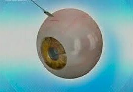 Искусственная роговица глаза на службе у израильских офтальмологов